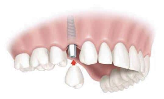 Dental implant diagram showing tooth replacement procedure in jawbone with prosthetic tooth model.