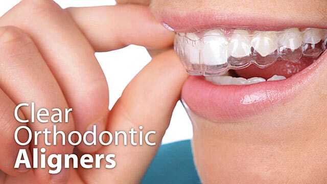Clear Orthodontic Aligners