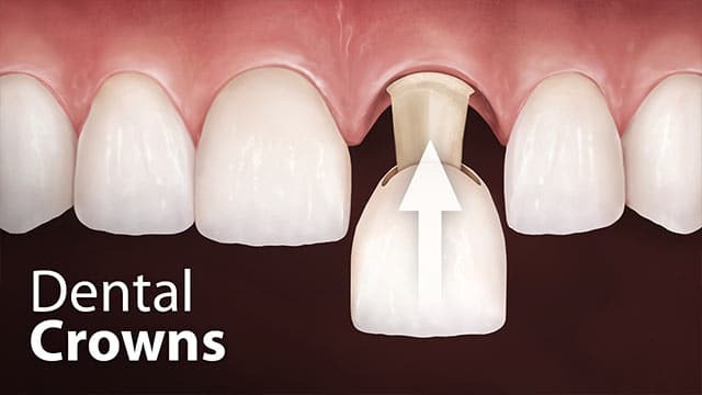 Dental Crowns