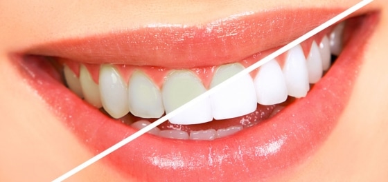 Close-up of bright white teeth and healthy pink gums with a dental shade guide comparison tool.