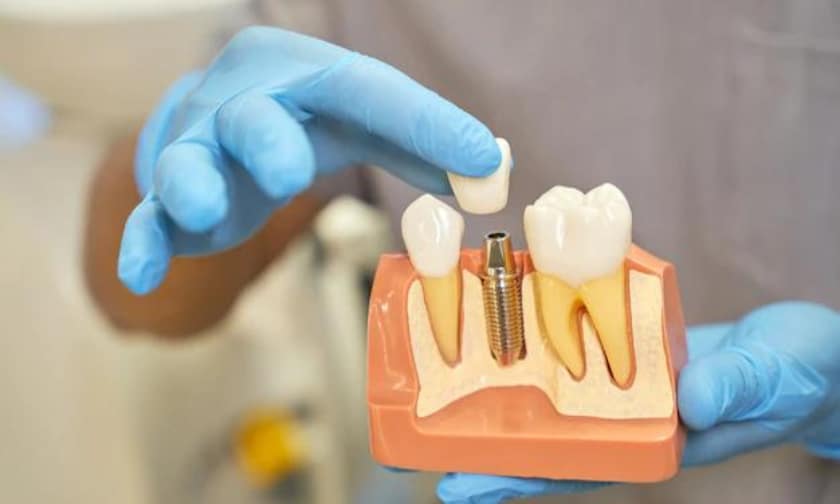 Dental Implants Fayetteville