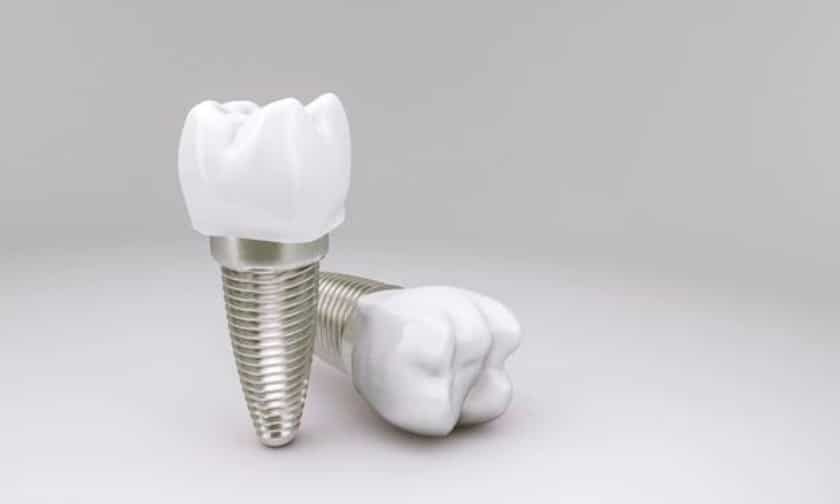 Dental Implants in Fayetteville