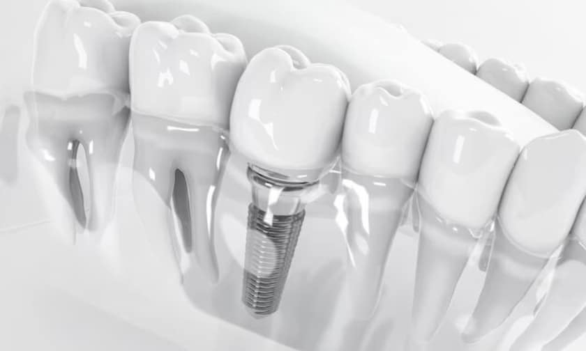 Dental Implants Fayetteville