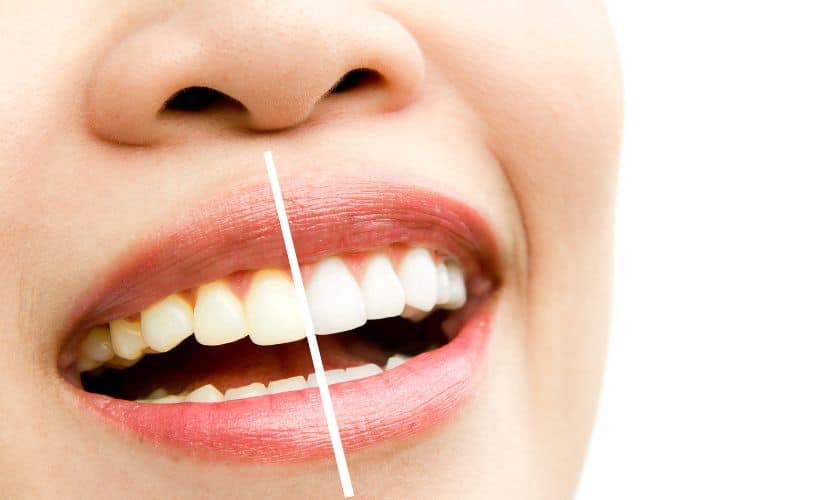 Zoom Whitening
