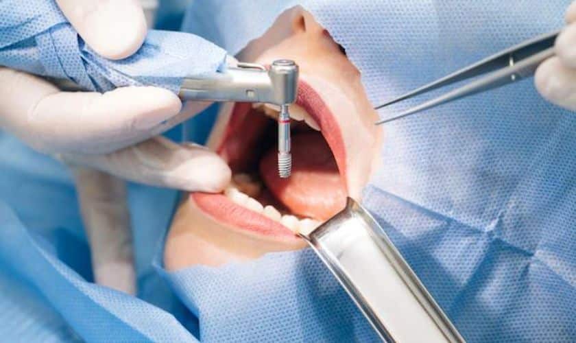 Implant Dentist Fayetteville