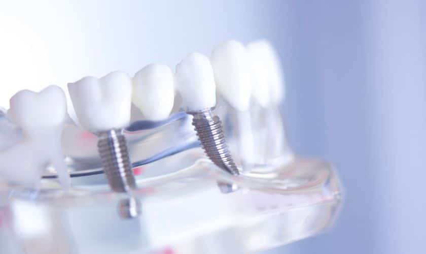 negatives of dental implants