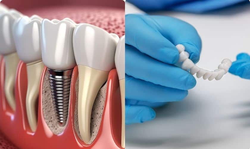 Dental Bridge vs. Implant: Choosing the Right Option for Your Smile