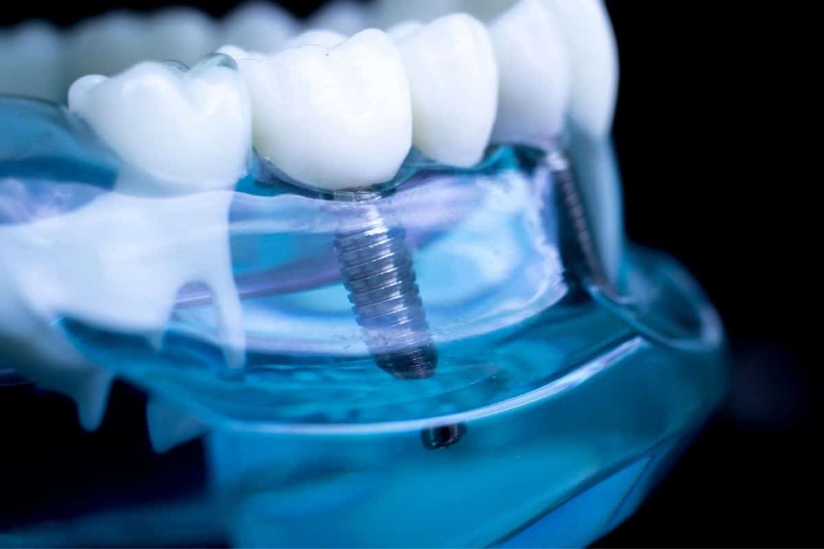 How many tooth implants can be done at once?