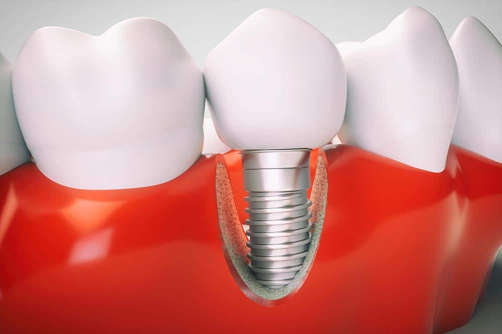 Dental implant diagram showing artificial tooth fixture in red gum tissue with adjacent natural teeth.